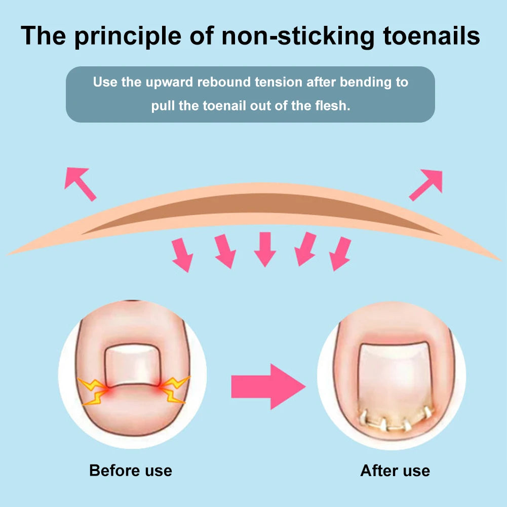 Ingrown Toenail Corrector Tool Embed Toe Nail Care Ingrown Toenail Pedicure Tool Curved Clamp Toenails Correction Tool
