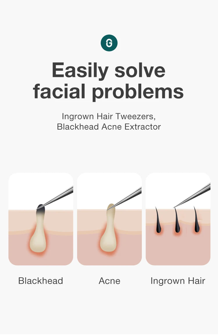 Ingrown Hair Tweezers Needle Nose Pointed Tips Eyebrows Tweezers For Splinters Blackhead Removal Acne Clip Extractor