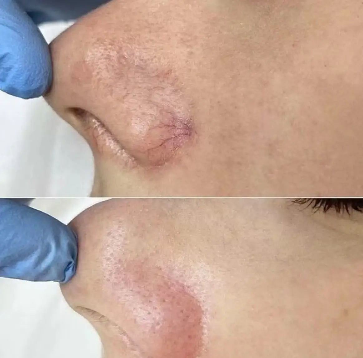 BEST 60W 6 in 1 Diode Laser 980nm Spider Vein Removal Machine Nail Fungus Removal Machine Remove Red Blood spider Veins